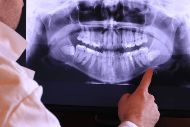 Best Knocked-Out Tooth (Avulsed Tooth) Treatment in Coram, NY